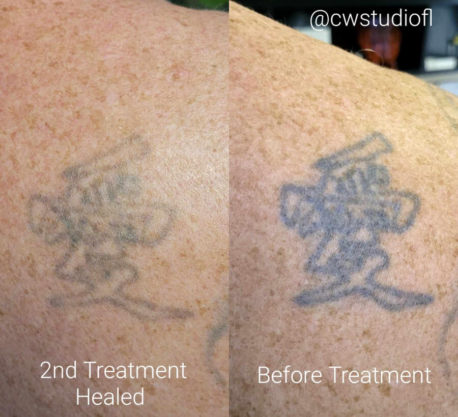 Laser Tattoo Removal Tattoo Removal Services in Edgewater, FL