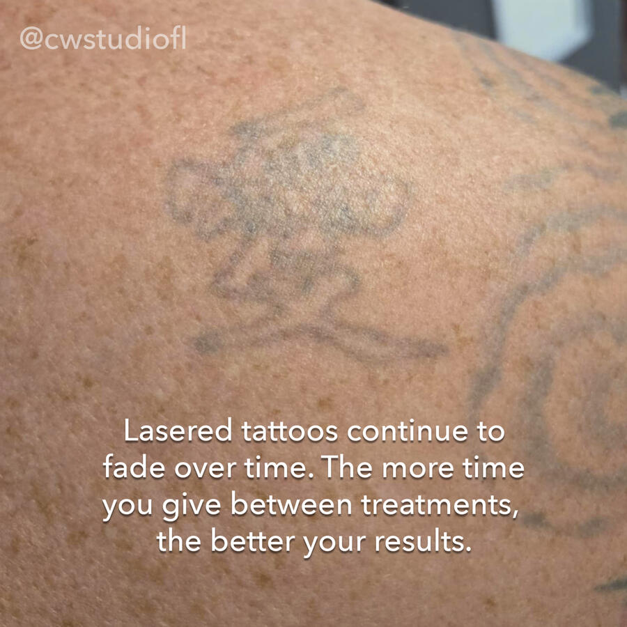 Tattoo Removal Services in Edgewater, FL